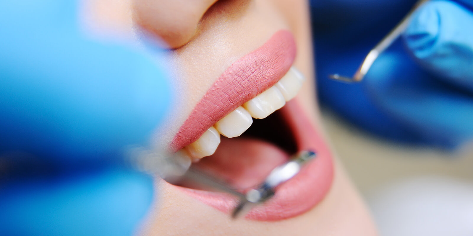当院の虫歯治療の特徴について