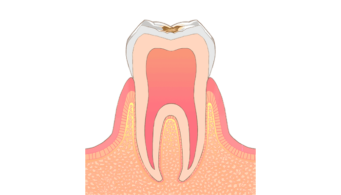 C1：痛みのない小さな虫歯