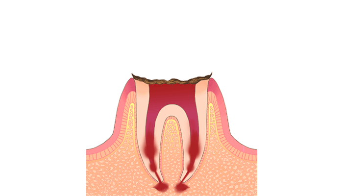 C4：歯の根だけ残った末期の虫歯