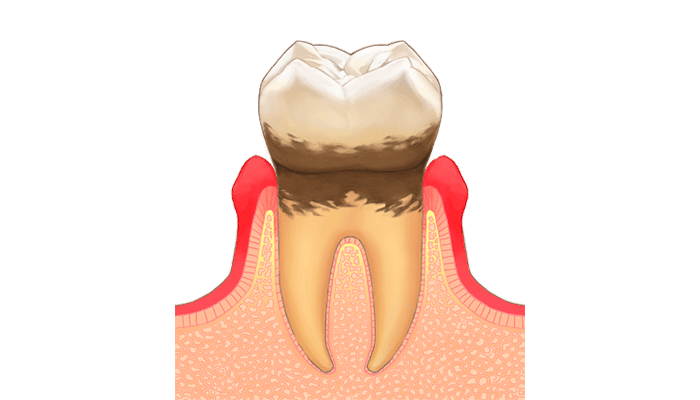 軽度歯周炎：歯肉の腫れや歯石の沈着がある軽度の歯周病