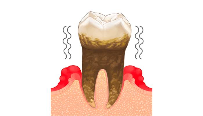 重度歯周炎：歯が動いたり浮いてきたりする歯周病
