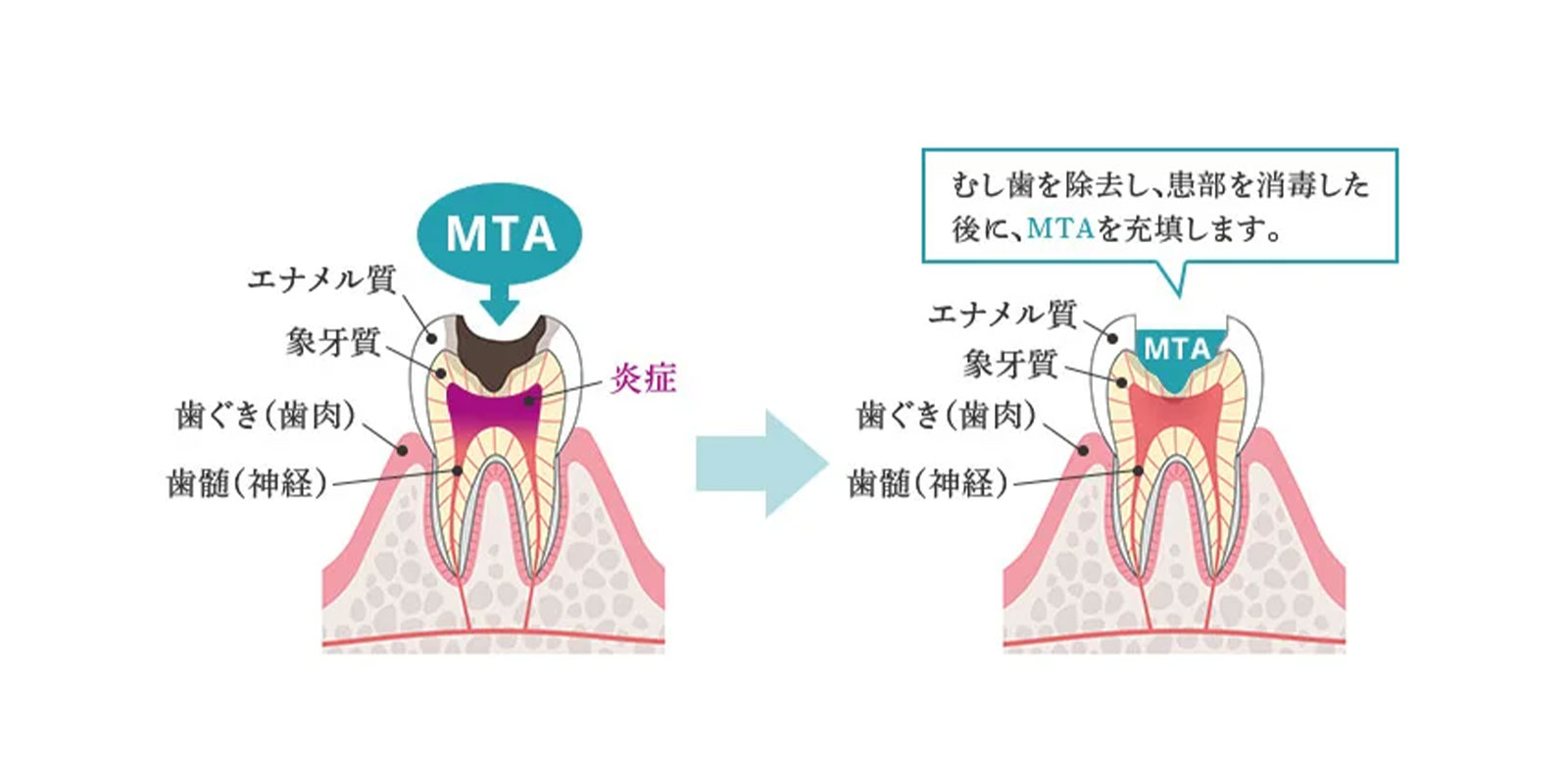 直接覆髄法